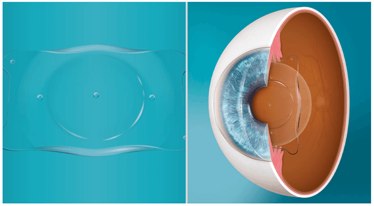 ICL with Eye