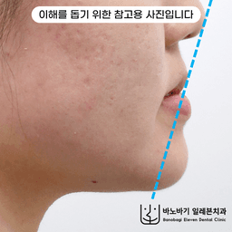 주걱턱 이야기 5. 주걱턱과 긴 턱, 그리고 안면비대칭의 썸네일