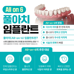 풀아치 임플란트_이미지