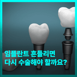 임플란트 흔들리면 다시 수술해야 할까요?의 썸네일