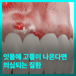 잇몸에 고름이 나온다면 의심되는 질환의 썸네일