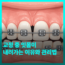교정 중 잇몸이 내려가는 이유와 관리법의 썸네일