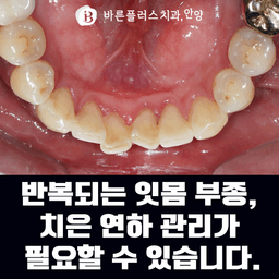 반복되는 잇몸 부종, 치은 연하 관리가 필요할 수 있습니다.의 썸네일