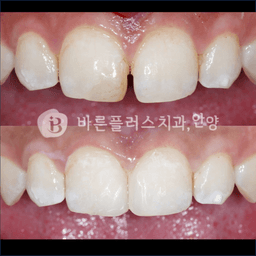 벌어진 앞니(대문치아)에대한 보존적이며, 가성비가 우수한 레진치료의 썸네일