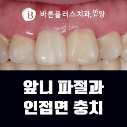 앞니 파절과 인접면 충치의 썸네일