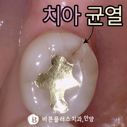 깨진 치아로인한 통증. 지르코니아크라운을 통해서 극복하기의 썸네일