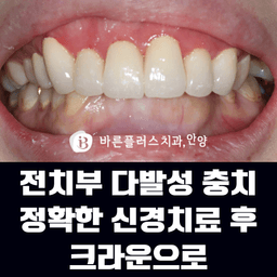 전치부 다발성 충치, 정확한 신경치료 후 크라운으로 회복한 사례!의 썸네일