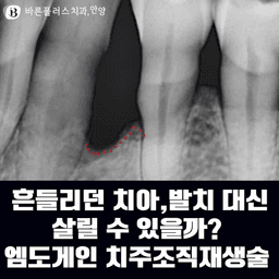 흔들리던 치아, 발치 대신 살릴 수 있을까? 엠도게인 치주조직재생술 케이스의 썸네일