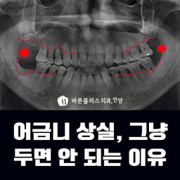 어금니 상실, 그냥 두면 안 되는 이유!의 썸네일