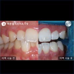 미백치료. 검증된 재료를 통해서, 안전하고 효과적으로!의 썸네일