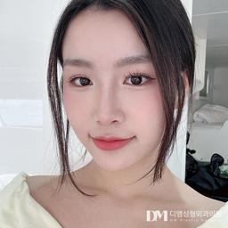 뒤밑트임으로 자연스럽게 트인 눈매 가능할까?의 썸네일