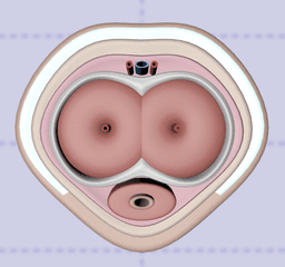 포경수술과 남성수술에서 표재근막의 중요성의 썸네일