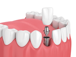 임플란트가 빠졌어요의 썸네일
