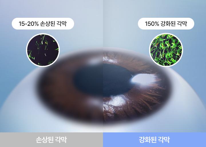 각막강화술의 역할은? (2026) | 모두닥