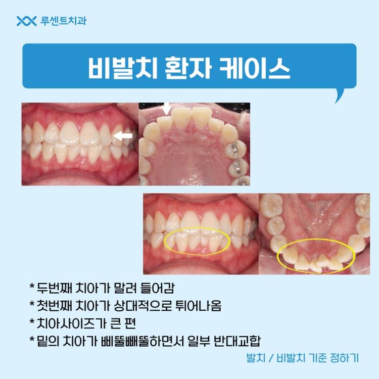 발치 비 발치 기준 딱 정해드립니다 (2026) | 모두닥